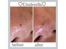 シンデレラ しみケア(Cinderella)/毛穴洗浄＋Wax＋毛穴縮小マシン