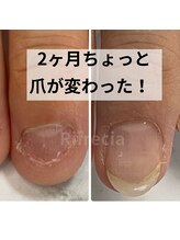 リフレシア(Rifrecia)/深爪矯正【千葉県柏　我孫子】