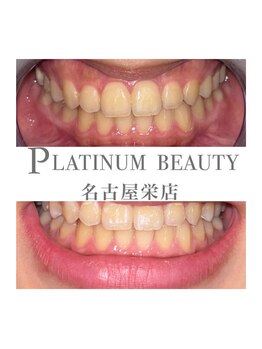プラチナムビューティー 名古屋栄本店(PLATINUM BEAUTY)/お客様Before After