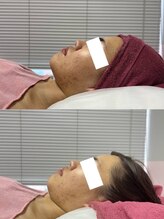 ヤワラ 長与店(yawara)/ハーブピーリング