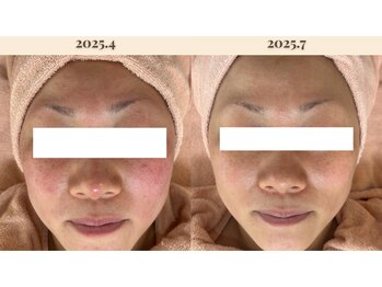 ミュー 春日井店(mieux)/◆肌質改善例