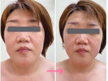 エステシオン(ESTESiON)/小顔