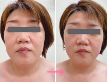 エステシオン(ESTESiON)/小顔