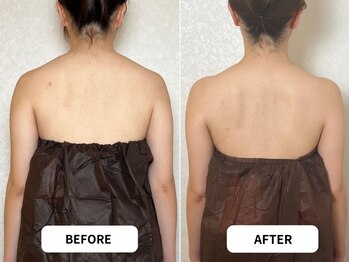 優子さんの美容矯正サロン/肩甲骨を綺麗に出すブライダル