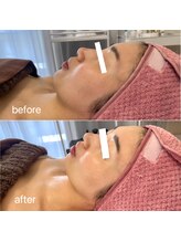 ルヴェール 久屋公園(le verre)/ララピール×EL美容液導入