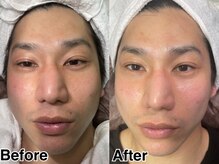 ティンクル(Twinkle)の雰囲気（男女問わず人気のプラン【毛穴洗浄+輪郭矯正】で清潔感アップ♪）
