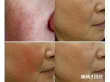 ナチュレアンドメディカ(Nature&Medica)/赤ら顔集中ケア(Wフェイシャル)