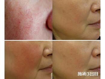 ナチュレアンドメディカ(Nature&Medica)/赤ら顔集中ケア(Wフェイシャル)