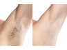 【脱毛】夏までに見せられる脇へ！脇脱毛※男女可能