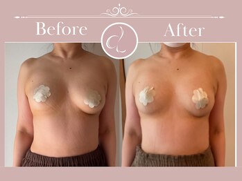 美バストアルファ(美bust α)/【バストアップ】症例