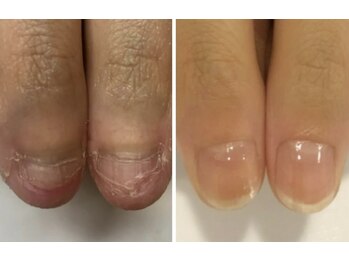 ティアラネイル 宇都宮/深爪矯正