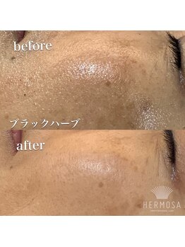 リボーン(re born.)の写真/たるみ・毛穴・透明感溢れる素肌へ|エルモサハーブピーリングで叶える本格肌質改善