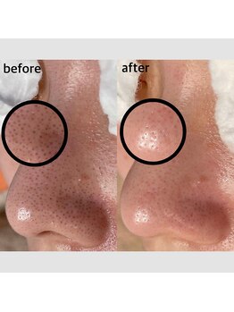 毛穴専科/毛穴洗浄◇ 学割u24あり