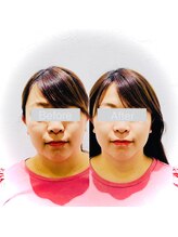 ワカヤマ 小顔(Wakayama)/☆Before・After☆