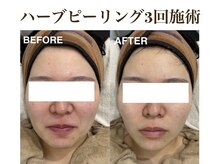 ティアム バイ テトテ 神戸三宮(TIAM by tetote)/ハーブピーリング