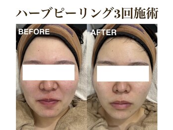 ティアム バイ テトテ 神戸三宮(TIAM by tetote)/ハーブピーリング