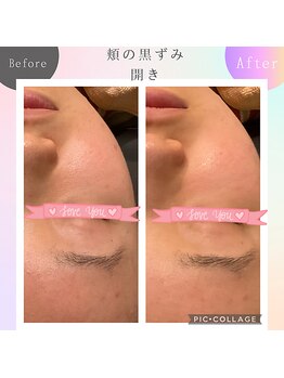 パルティノ 高崎店/毛穴洗浄・毛穴ケア