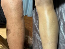 リボーン(REBORN)/メンズのツルスベ脱毛