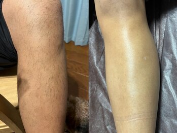 リボーン(REBORN)/メンズのツルスベ脱毛