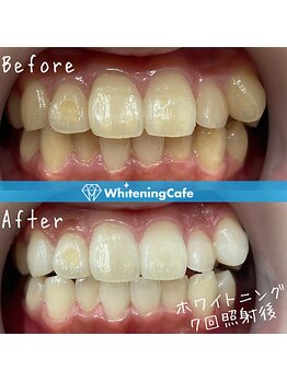 ホワイトニングカフェ 三島店/★Before→ After