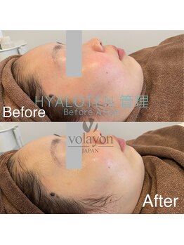 ワイズデュー(Y's Dew)/volayon緑：ベルドソ 鎮静・敏感