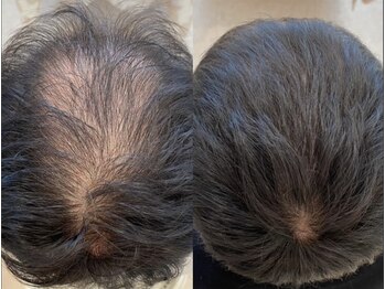 カナエル ビューティーサロン(Canael Beauty salon)/プロセルセラピーズ 2回