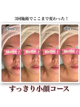 ルアナライフ(Luana Life)の写真/小顔リンパマッサージで憧れのフェイスラインへ!スッキリ二重アゴ、たるみ毛穴もケアし老け見え改善◎