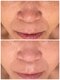 シェノン(Chainon)の写真/たるみ/たるみ毛穴/ほうれい線/肩こり/年令による悩み集中特化！