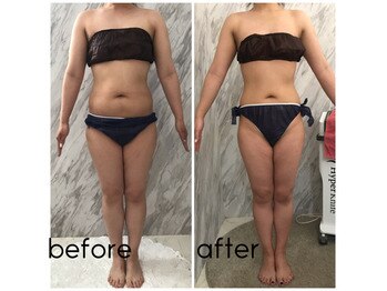 ラニ(LANI)/新型ハイパーナイフ6