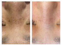 スキンラボ 新宿(@SkinLabo)/【プラズマトータル＆シミケア】