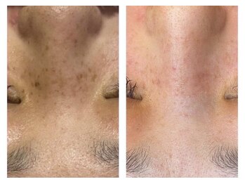 スキンラボ 新宿(@SkinLabo)/【プラズマトータル&シミケア】