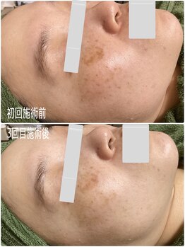 ブライトリー(Brightly)/最新光で本気のシミ改善3回目!