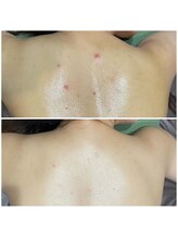 アースコアフュールボーテ 小山店(EARTH coiffure beaute)/背中ハーブピーリング