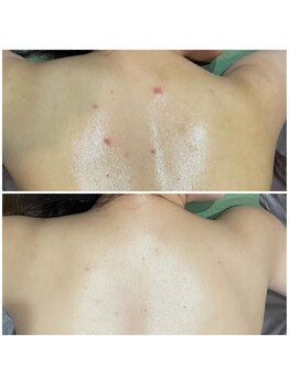 アースコアフュールボーテ 小山店(EARTH coiffure beaute)/背中ハーブピーリング