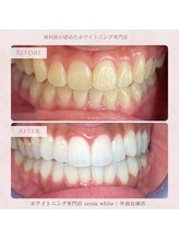 エクシアホワイトニング 札幌中島公園店/Before After［ホワイトニング］