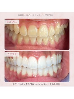 エクシアホワイトニング 札幌中島公園店/Before After［ホワイトニング］