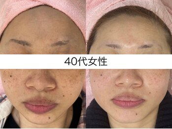 サクラ 本厚木駅前店(SAKURA)/42歳 6回の写真【フェイシャル】