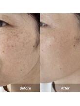 癒える(ielu)/ダイヤモンドピール2回目