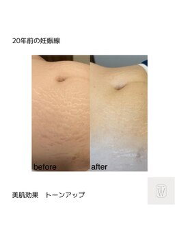 スロウ(THROW)/インディバ　美肌・トーンアップ