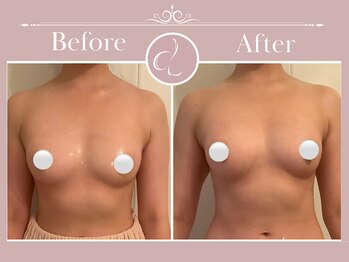 美バストアルファ(美bust α)/【バストアップ】症例