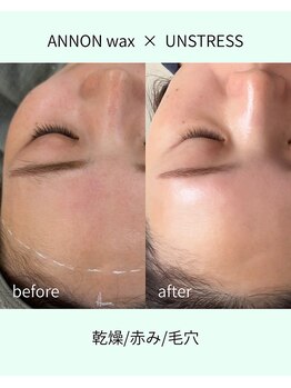 サロン ラン(salon rann)/乾燥肌/face &nbsp;wax × UNSTRESS
