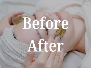 アミュレット(Amulette)/Before/After[麻布十番/毛穴]