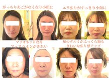 サロンドエステケイワイ(de KY)の雰囲気（人気の小顔、タルミ改善。顔・首・肩まで整え左右の歪みも改善。）