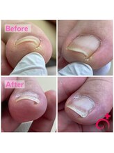 Dr.巻き爪 札幌北一条東院/40代女性！驚きの技術！