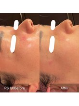 サンベリーナ(Thumbelina)/