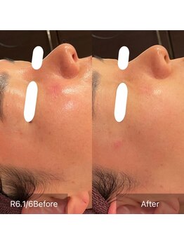 サンベリーナ(Thumbelina)/