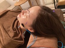 ハリファ鍼灸院 横浜関内院(HariFa鍼灸院)/美容施術