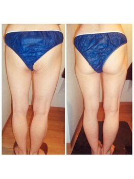 おいかわ整骨院/メディセルで60代で美脚に