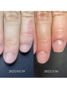 ココ(COCO)/ハンドケア・自爪育成・深爪育成