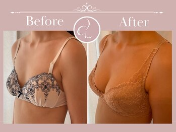 美バストアルファ(美bust α)/【バストアップ】症例